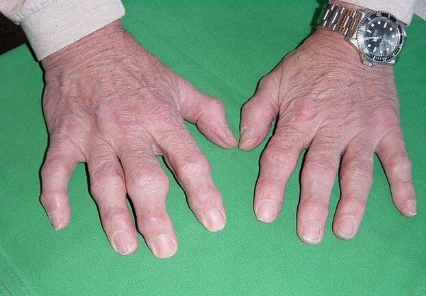 Osteoartrosi delle dita