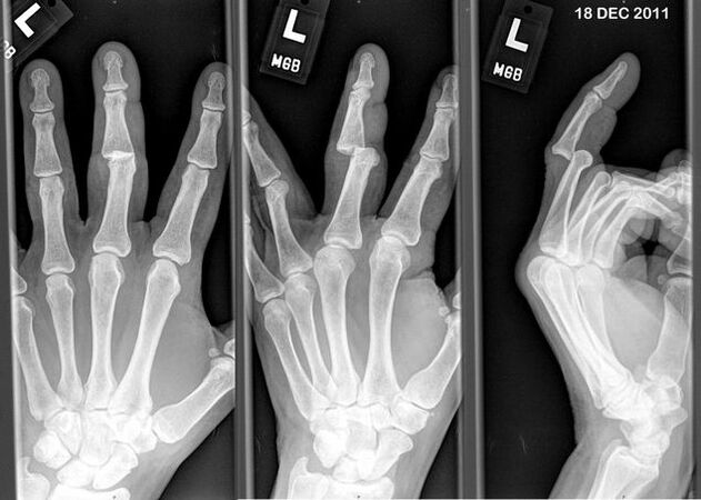 Radiografia delle dita lussate