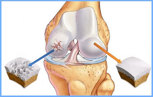 Articolazione del ginocchio normale e affetta da osteoartrite