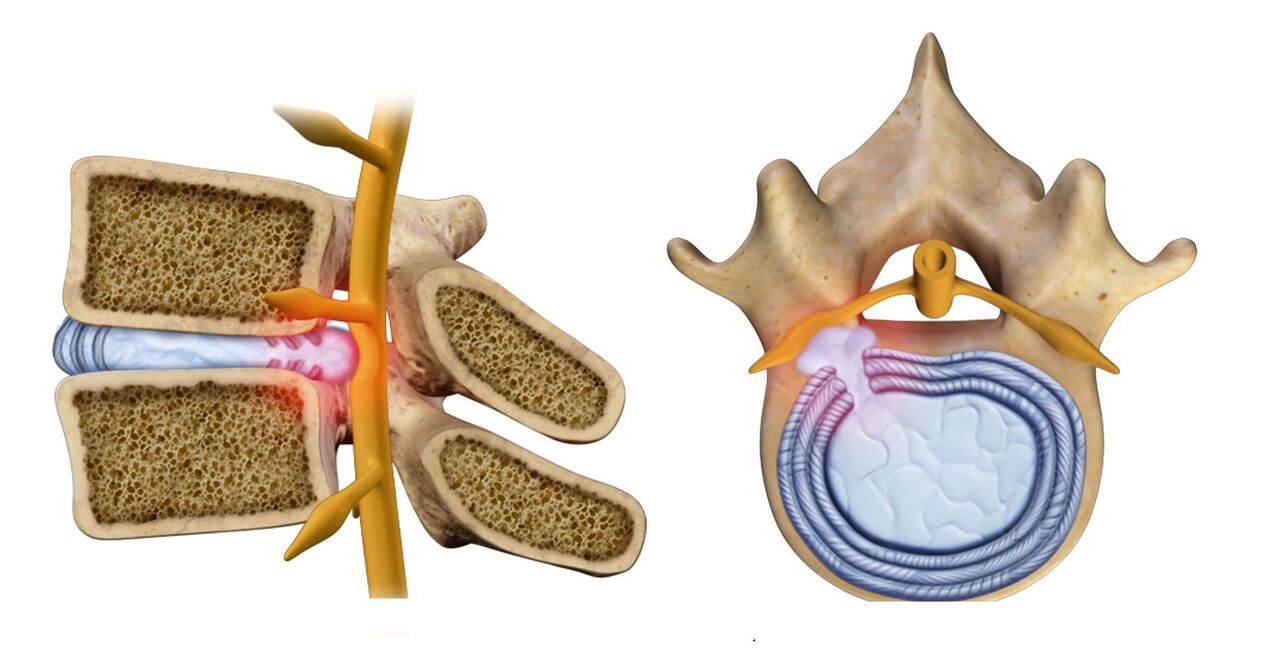Ernia spinale nell'osteocondrosi toracica