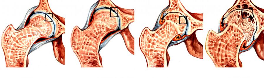 Il grado di sviluppo della coxartrosi dell'articolazione dell'anca