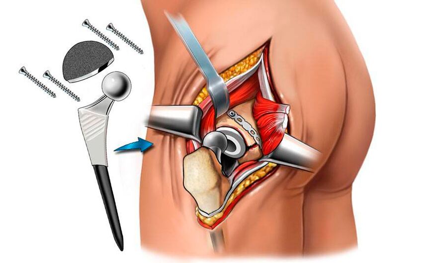 Installazione di un'endoprotesi una soluzione chirurgica al problema della coxartrosi