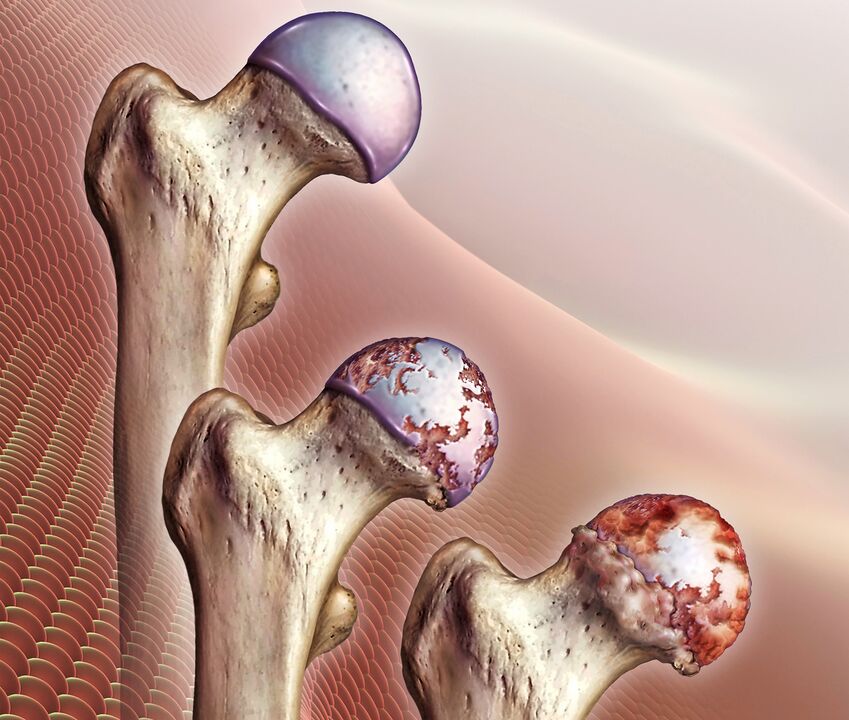 Lo sviluppo dell'artrosi dell'articolazione dell'anca