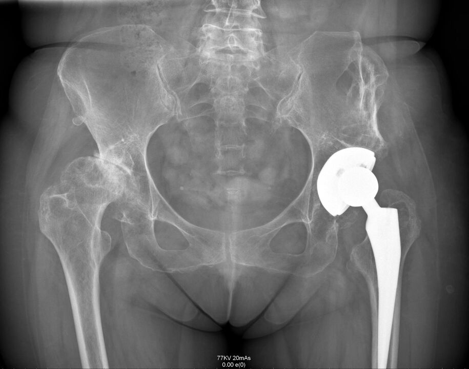 Radiografia dell'articolazione dell'anca dopo l'endoprotesi