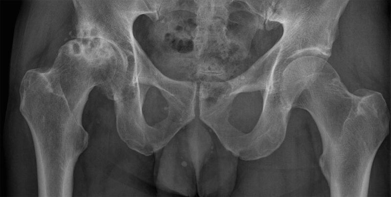 Radiografia dell'artrosi deformante dell'articolazione dell'anca