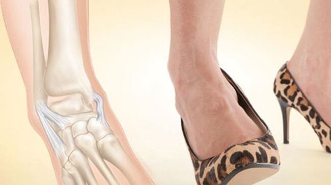 Indossare i tacchi come causa di artrosi alla caviglia