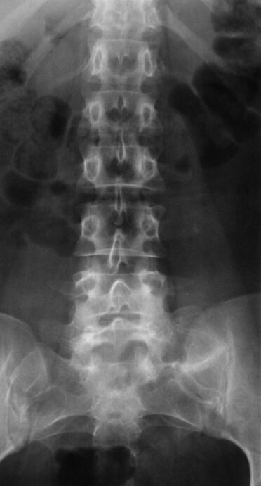 Per diagnosticare l'osteocondrosi lombare, viene eseguita una radiografia