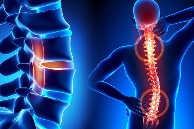 Osteocondrosi della colonna vertebrale